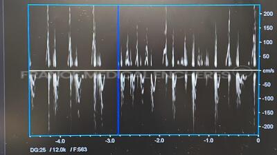 Hitachi Ultrasound Artida SSH 880CV - YOM 2012 - S/W AA V2.7 - w/ PST-30B probe - PST-50BT - CW Doppler pencil PC-20M - ECG sensors (Powers up) - 17