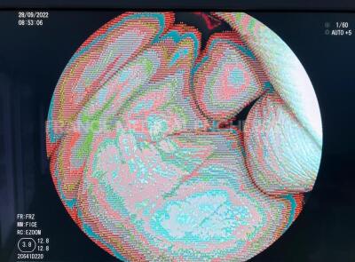 Fujinon Colonoscope EC-530WM3 - Engineer's report : Optical system image issue ,Angulation no fault found , Insertion tube no fault found , Light transmission no fault found , Channels no fault found, Leak check no fault found - cone damaged - 8