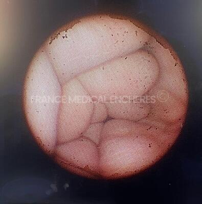 Olympus Bronchoscope BF-PE2 Engineer's report : Optical system 50 black dots ,Angulation no fault found , Insertion tube no fault found , Light transmission no fault found , Channels no fault found , Leak no fault found no distal sheath *2302962* - 2